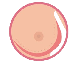 Lump in Breast