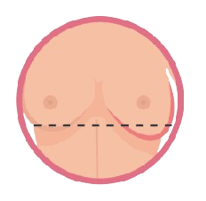 Changes in Breast Shape